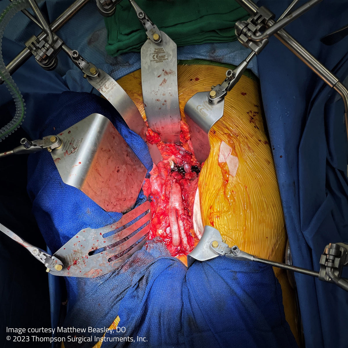 Evaluating table-mounted retractor sets