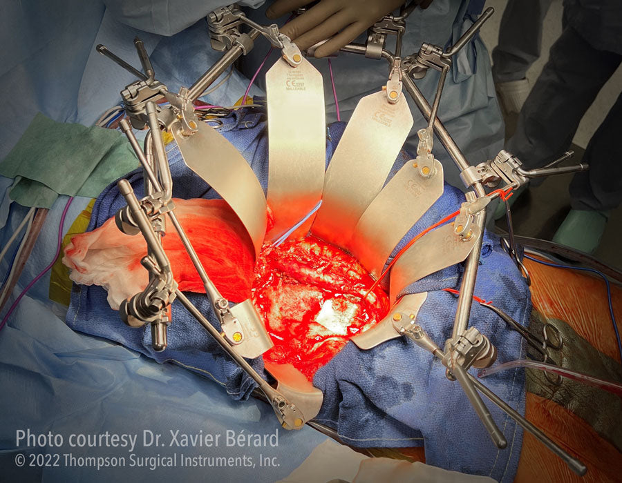 Frame Styles Explained: OneFrame vs Wishbone for Deep Aortic Exposure