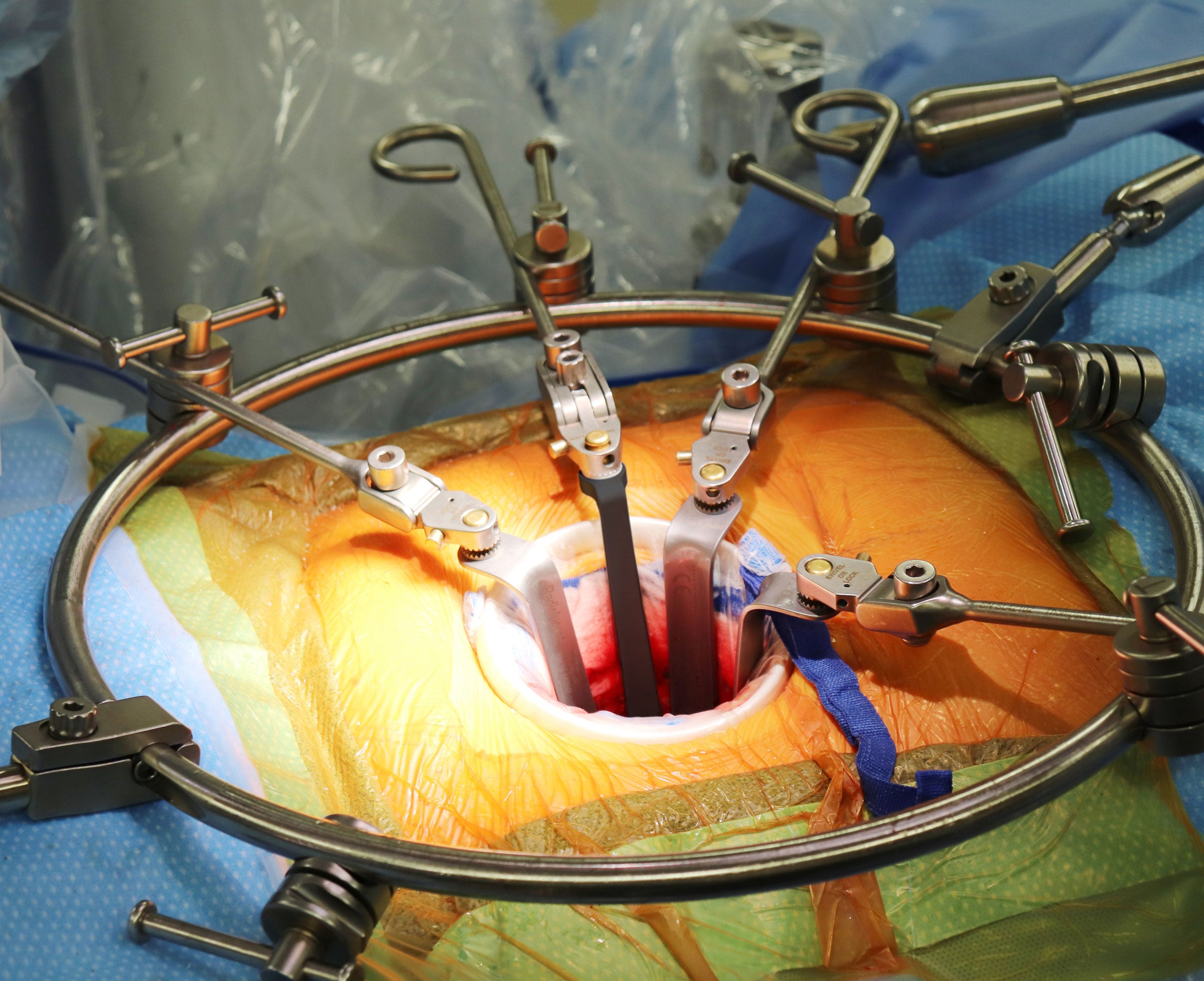 table-mounted retractor for spine surgery