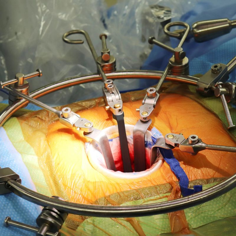 anterior lumbar exposure