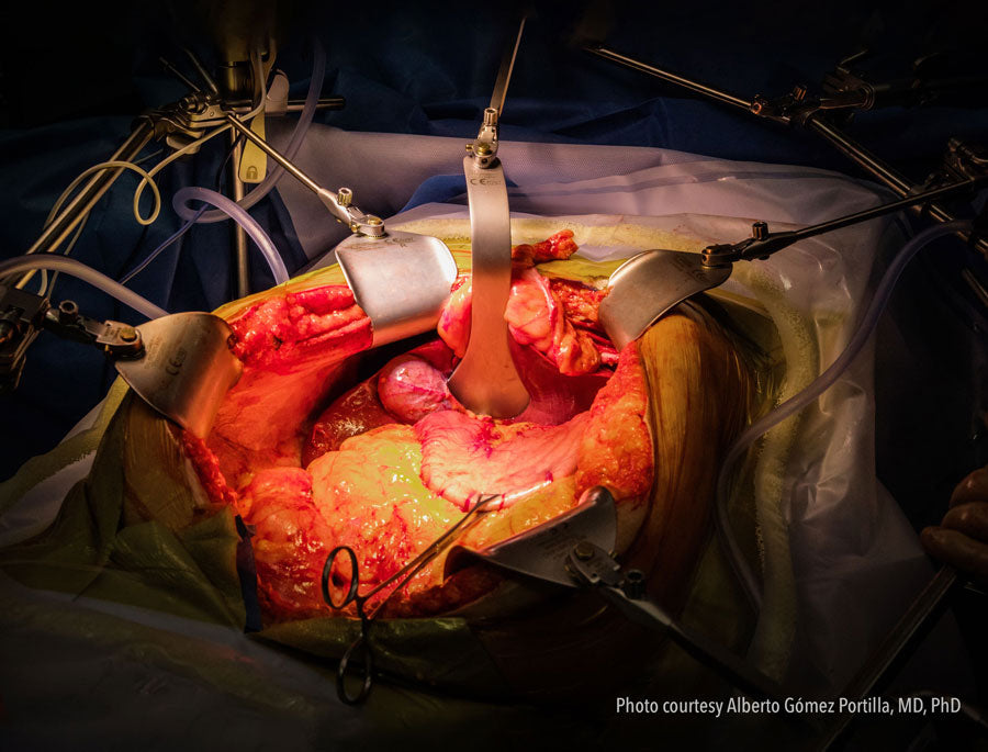 Why Table-Mounted Retractors are Ideal for Complex Open Oncologic Resections