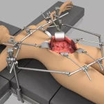Pelvic & GYN Oncology Exposure: Optimizing Deep, Stable Retraction for Complex Resections