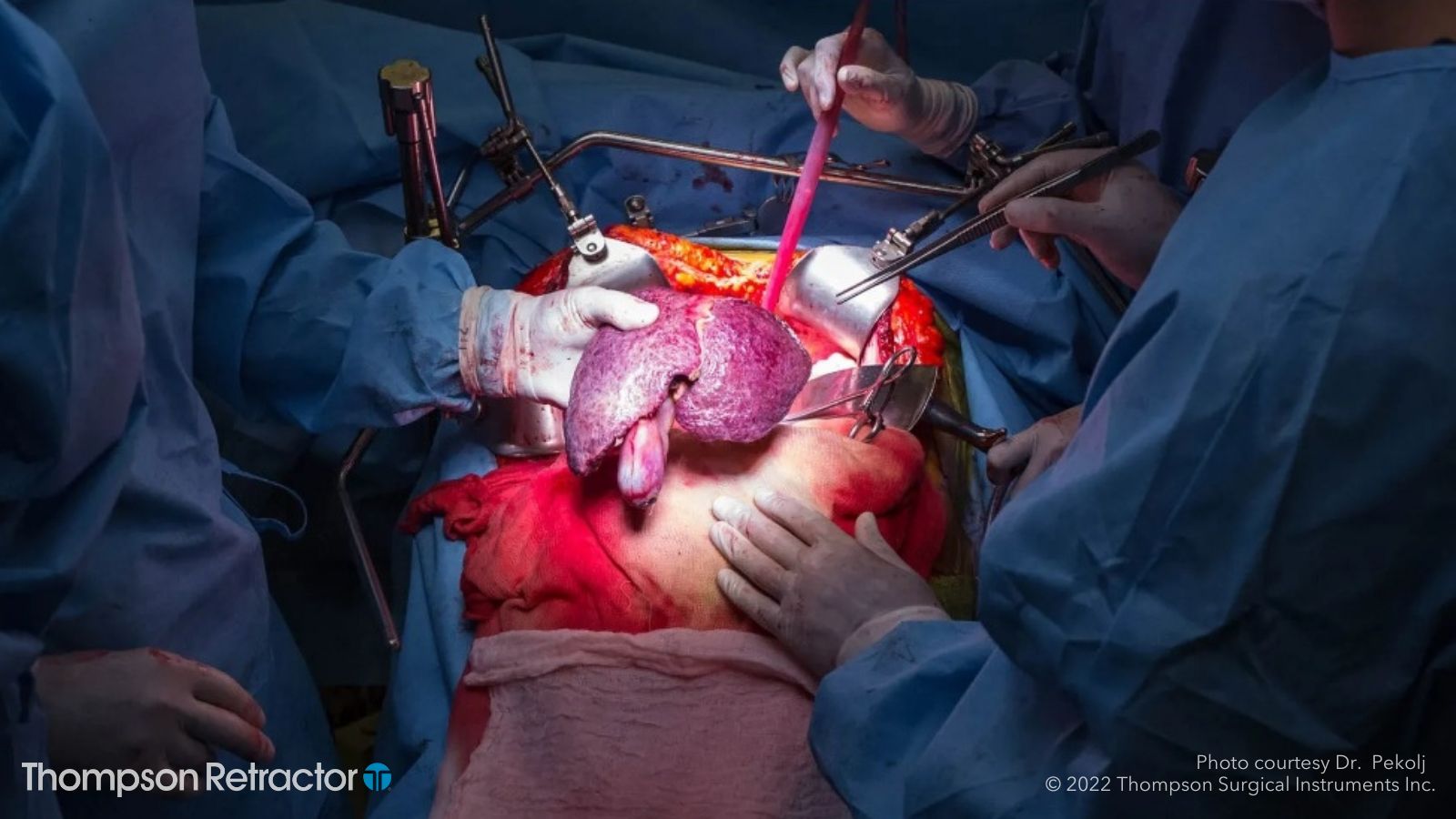 Thompson Retractor table-mounted retractor sets for liver procedures