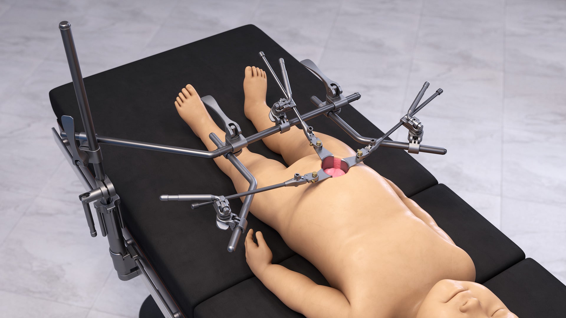Pediatric Abdominal QuickFrame Retractor Set