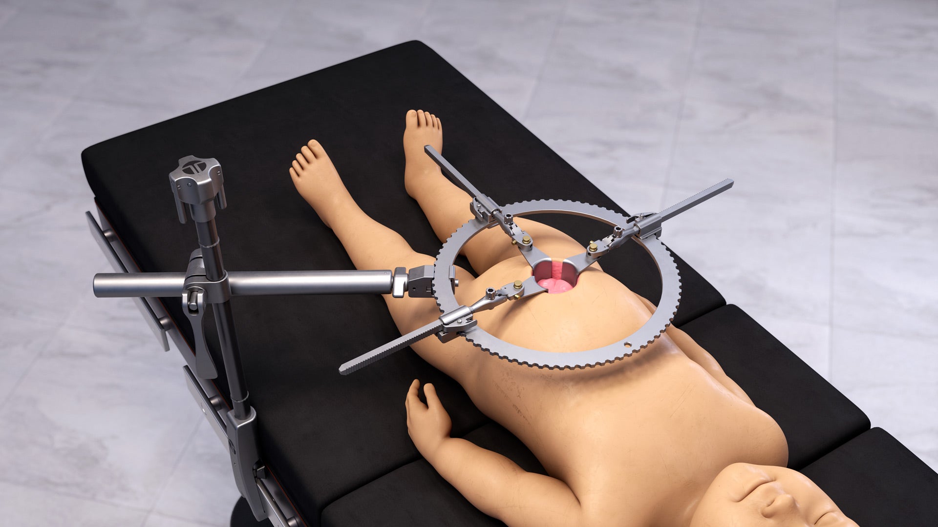Pediatric Abdominal RingTrack Retractor Set
