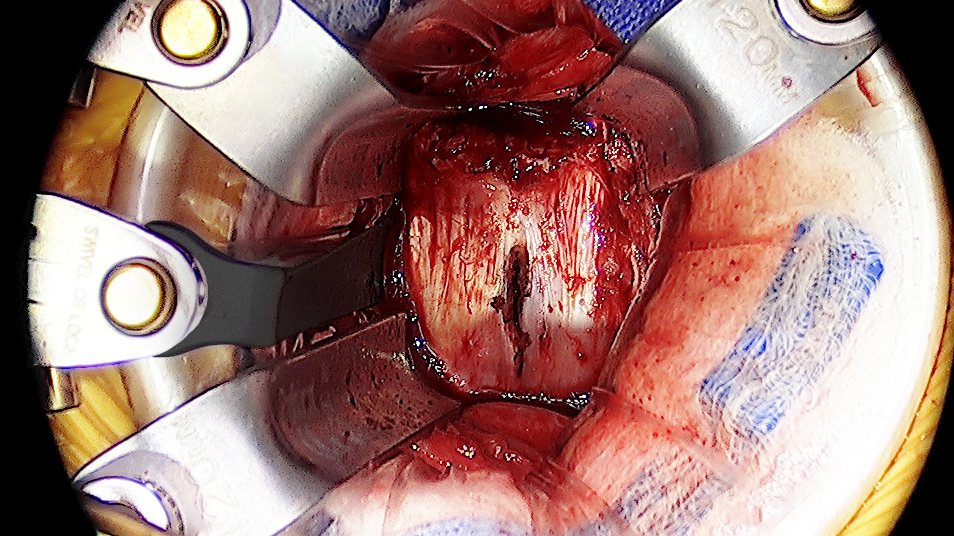 Clinical image AL Ring 2 # – Thompson Surgical